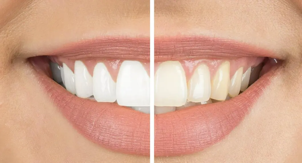 Consejos sencillos para mantener los dientes blancos sin gastar mucho dinero