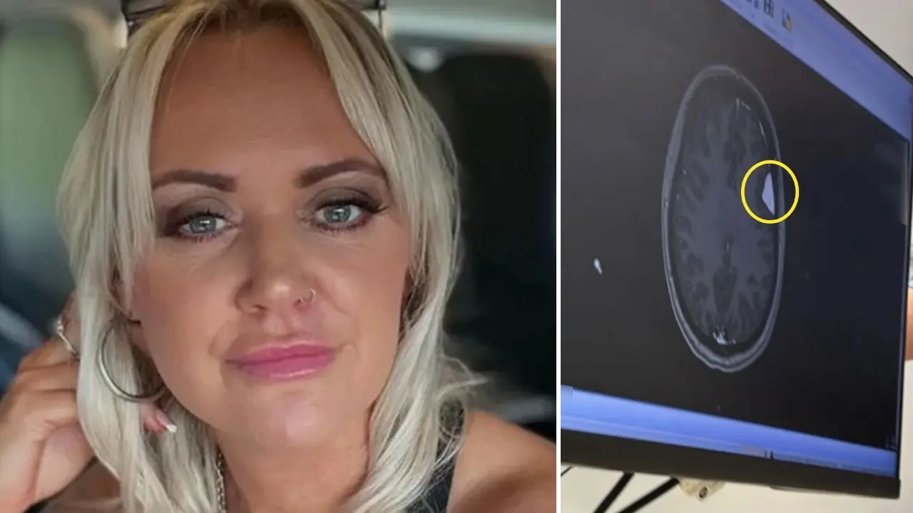 Mujer que tomó anticonceptivos por más de 20 años resultó con cuatro tumores cerebrales