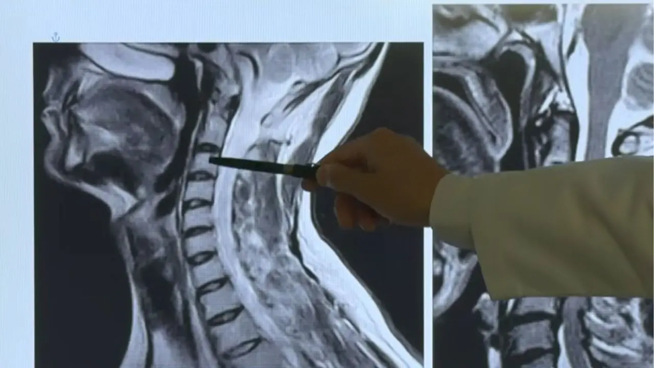 Alerta por síndrome de cuello de texto: este es el grave riesgo para la columna cervical